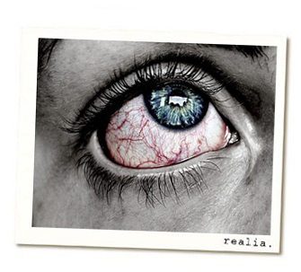 A red, inflamed eye